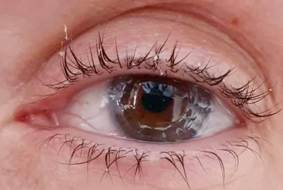 Urgent need for cornea donors to help restore sight of transplant patients