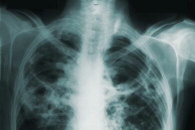 Bradford Teaching Hospitals welcomes Artificial Intelligence (AI) technology innovation in Radiology to improve patient care